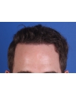 After Hair Transplant &nbsp;Front